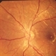 Autosomal Dominant Müller Cell Dystrophy OS Autosomal Dominant Müller Cell Dystrophy OS